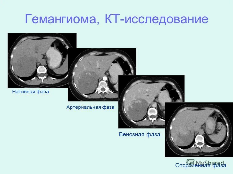 Очаговые гемангиомы печени. Атипичная гемангиома печени на кт. Капиллярная гемангиома печени мрт. Контрастирование печени кт. Контрастирование гемангиомы печени на кт.