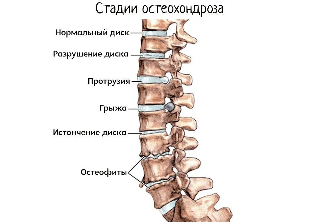 Остеофиты что это такое и как лечить. Остеохондроз позвоночного отдела 2 степени. Остеохондроз поясничного отдела 2 степени. Остеохондроз 1-2 степени поясничного отдела. Остеофиты позвоночника поясничного отдела.