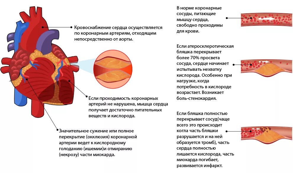 Образование тромба при инфаркте миокарда. Типы коронарного кровоснабжения сердца. Сердечная недостаточность при инфаркте миокарда