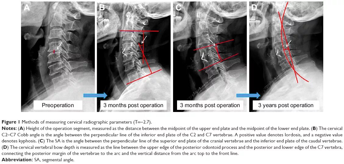 Interbody Fusion Cage. Cervical Expandable Cage. Cervical Expandable Cage KT. Osteoporosis 2 Grade XRAY cervical.