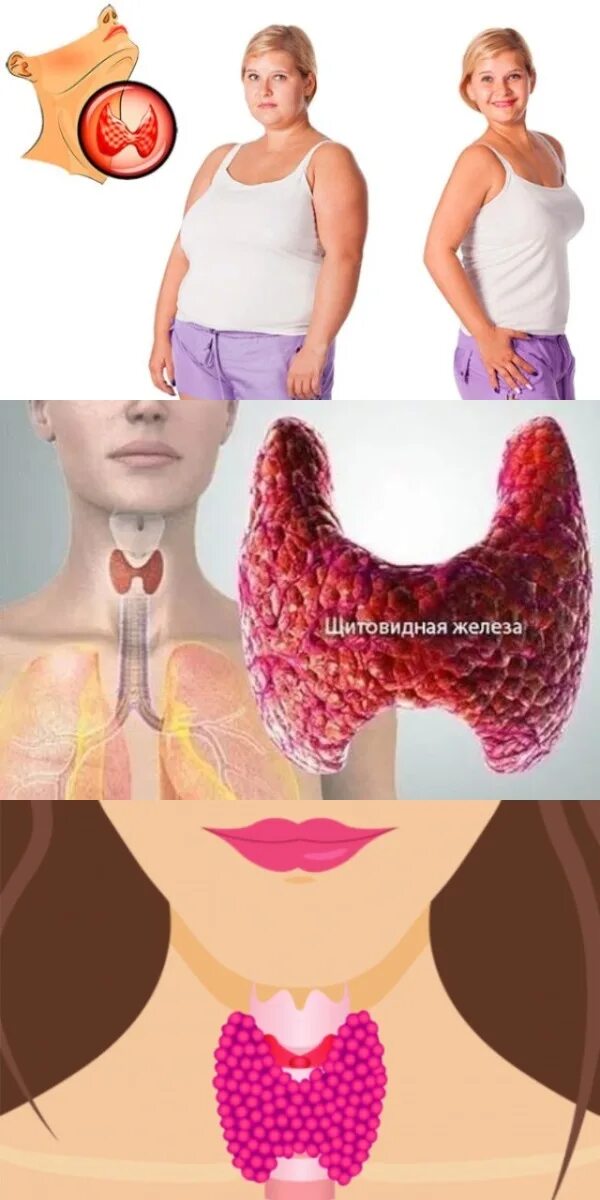 Щитовидная восстановилась. Здоровая щитовидная железа. Здоровая и больная щитовидка. Здоровая щитовидная железа у женщин.