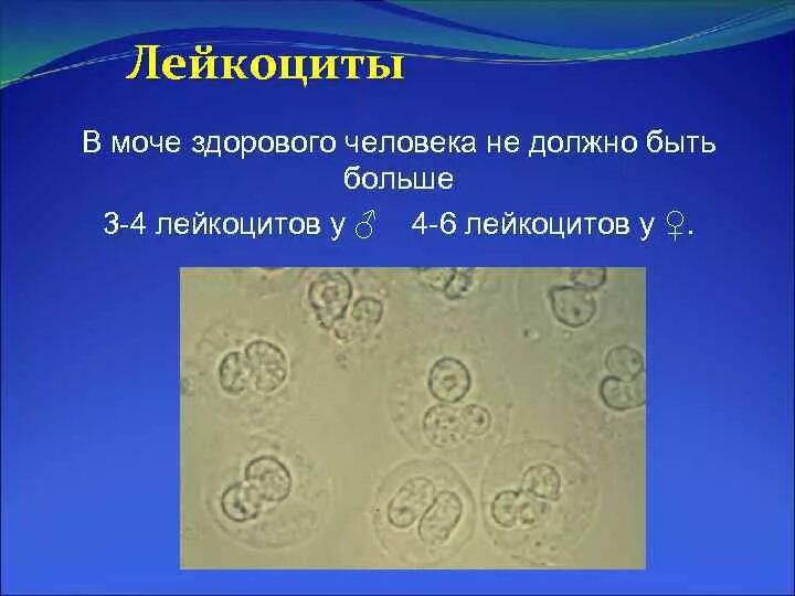 Лейкоциты в моче сильно. Лейкоциты микроскопия повышены. Лейкоциты в моче. Лейкоциты в моче в моче. Лейкоциты при микроскопия мочи.