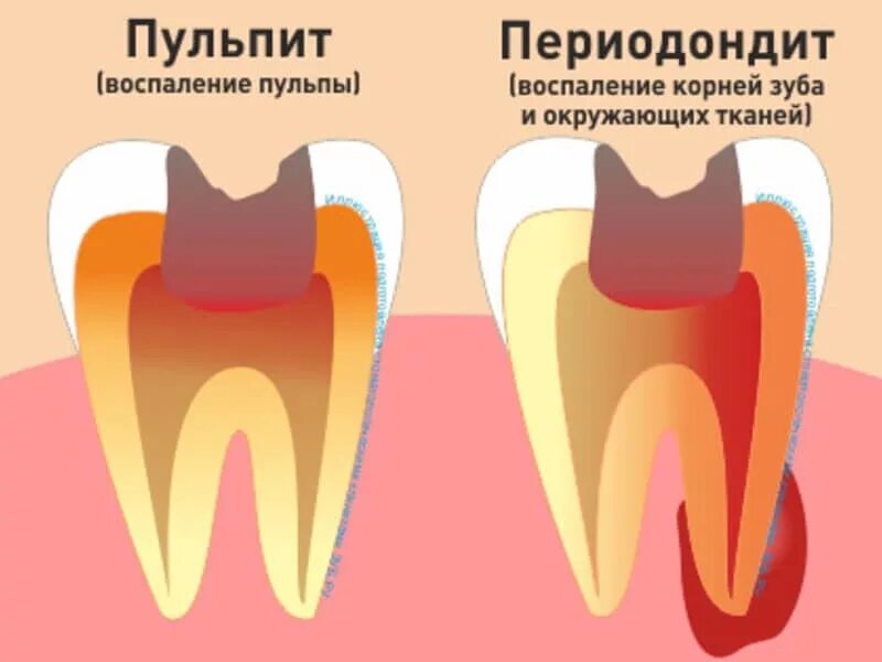 Воспаление канала зуба. Зубы кариес пульпит периодонтит. Разница кариес пульпит периодонтит.