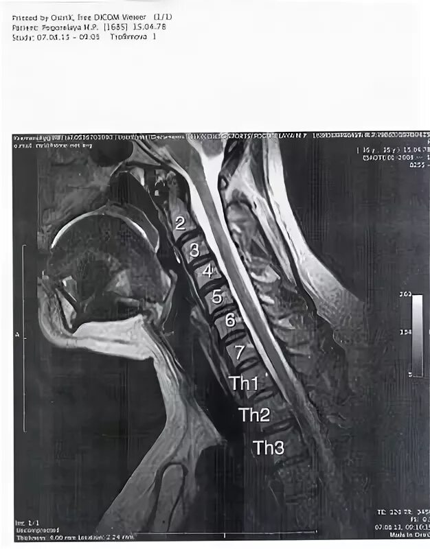 Грыжа 5 6 позвонка шейного. Протрузия с6 с7 шейного. Шейный отдел позвоночника c5-c6. Диски шейный отдел c3 c4. Диски шейный отдел c4 с5.