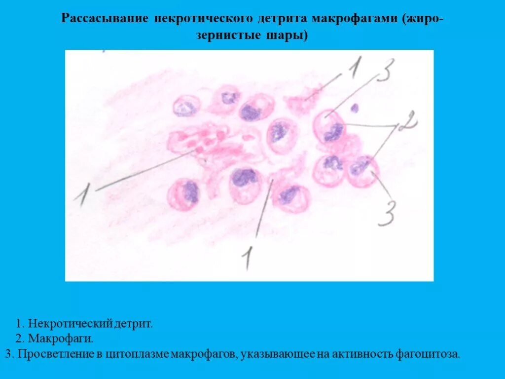 Детрит это. Некротический детрит гистология. лейкоцитарно некротический детрит что это такое.