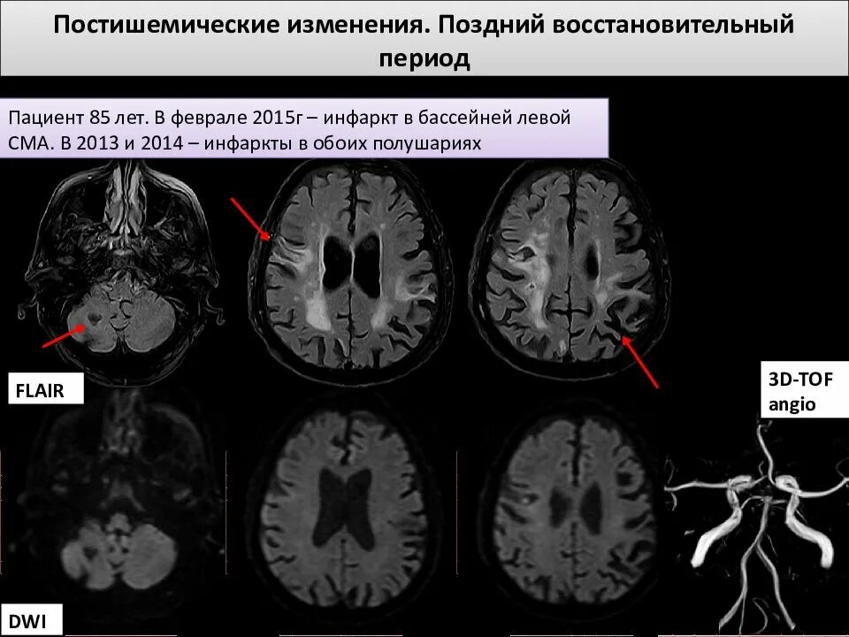 Ишемический инсульт в бассейне левой средней мозговой артерии. Ишемический инсульт на кт головного мозга. Бассейн средней мозговой артерии на кт. Постишемические изменения на кт. Резидуальные очаговые изменения