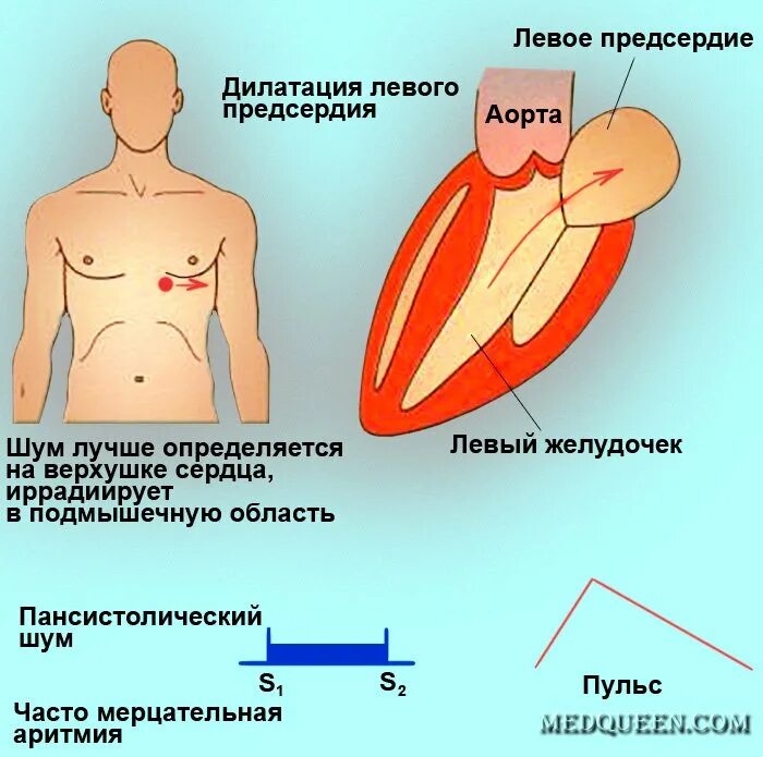 Дилатация полостей сердца. Дилатация полостей левых отделов сердца. Дилятация полости левого желудочка. Расширение полостей сердца. Левое предсердие увеличено