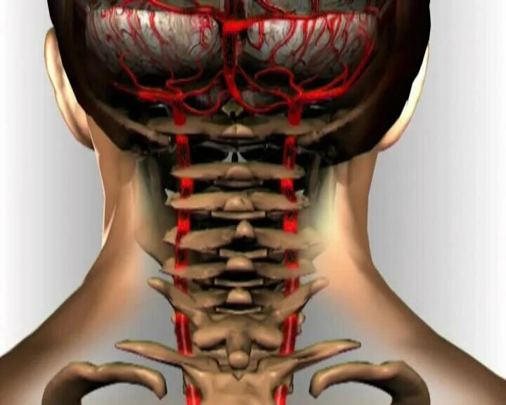 Болит шея у основания головы. Позвоночная артерия базилярная артерия. Синдром позвоночной артерии анатомия. Шейный синдром позвоночной артерии. Синдром позвоночной артерии снимок.