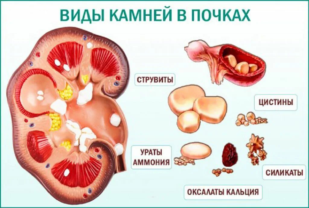 Камни в почках заболевание. Почечнокаменная болезнь.