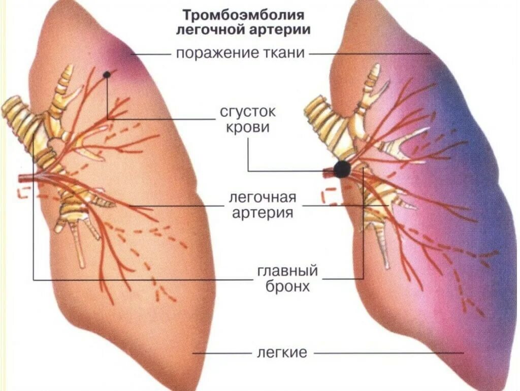 Тромбоэмболия ветвей легочной артерии. Тромбоэмболия легочной артерии симптомы. Тромб в легочной артерии. Тромбоз лёгочной артерии симптомы.