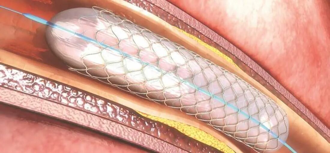 Болит стент. Коронарное стентирование. Полиуретановый стент поверхность.
