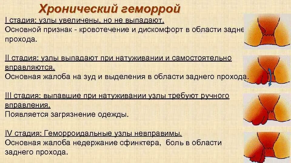Наружный геморрой - причины развития, классификация, симптомы, диагностика, лече