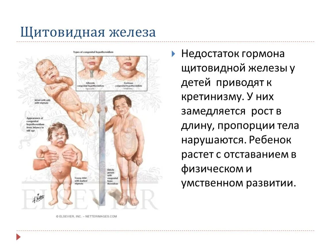 Заболевание гормона роста. При недостатке гормонов щитовидной железы в детском возрасте. Недостаток гармоно в щитовидной железы. Недостаток гормонов щи. Недостаток тиреоидных гормонов.