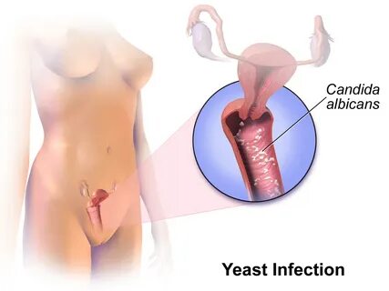 Vulvovaginal Candidiasis - TeachMeObGyn 