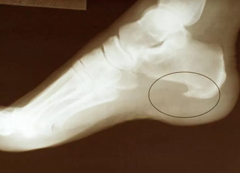 Плантарный фасциит симптомы. Пяточная кость шпора рентген. Задняя пяточная шпора рентген. Пяточный шип. Подошвенный экзостоз пяточной кости.