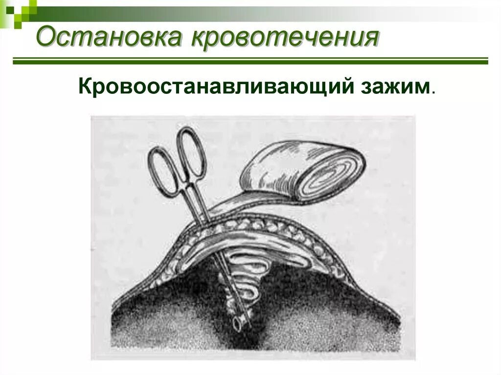 Наложение кровоостанавливающего зажима на кровоточащий сосуд. Наложение кровоостанавливающего зажима. Остановка кровотечения наложением зажима. Техника наложения кровоостанавливающего зажима.