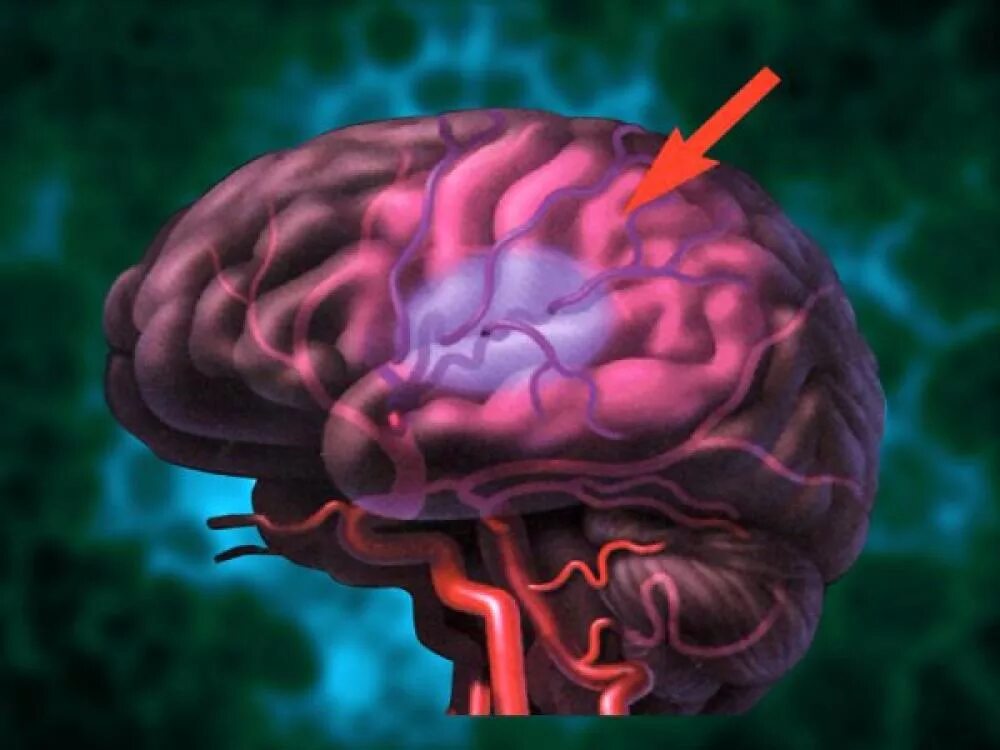 Левое полушарие мозга инсульт. Ишемия мозгового инсульта. Ишемия коры головного мозга. Ишемия сосудов головного мозга. Гипоксия сосудов головного мозга.