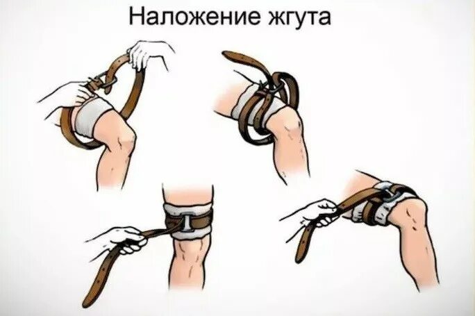 Какой жгут лучше. Наложение артериального кровоостанавливающего жгута. порядок наложения жгута на конечность. методика наложения жгута эсмарха при кровотечении.