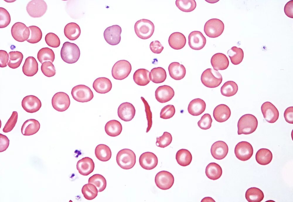 Эритроциты при серповидно клеточной анемии. Серповидноклеточная анемия мазок крови препарат. Картина крови при серповидноклеточной анемии. Мазок крови при серповидноклеточной анемии. Серповидноклеточная анемия эритроциты.