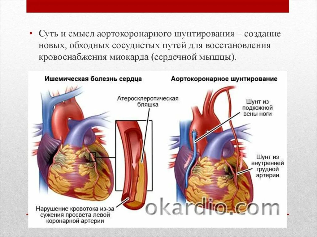 Аортокоронарное шунтирование. Схема аортокоронарного шунтирования. Кровоснабжение миокарда. Аортокоронарное шунтирование с искусственным кровообращением. Что такое шунтирование сердца и сосудов