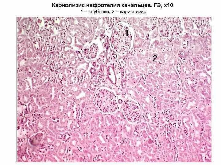 Кариопикноз это. Кариолизис это гистология. Кариопикноз кариорексис кариолизис. Кариопикноз гистология. Кариорексис микропрепарат.