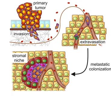 Metastasis