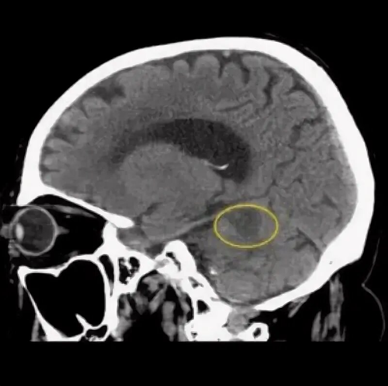 Очаги ишемии головного мозга. Ишемический инсульт кт и мрт. Ишемический инсульт снимок кт. Ишемический инсульт на кт головного мозга. Ишемический инсульт мозжечка YF RN.