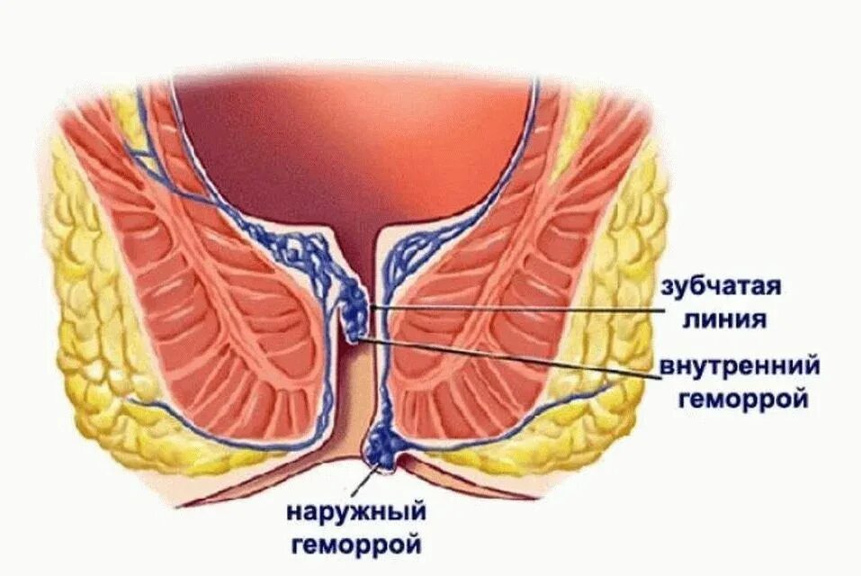 Боли внутри заднего прохода. Наружный и внутренний геморрой. Внутренний геморрой прямой кишки. Геморрой внутри прямой кишки.