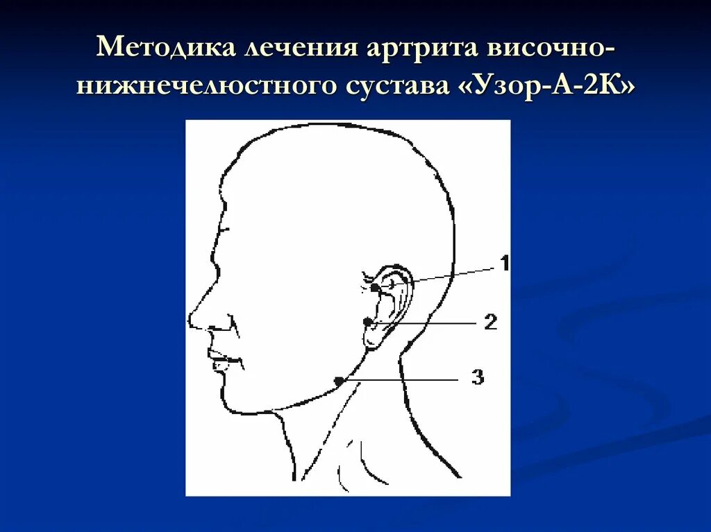 Дисфункциональные заболевания внчс. Суставные симптомы при заболеваниях внчс. Кт протокол височно-нижнечелюстного сустава. Артрит внчс (височно-нижнечелюстного сустава. Как лечить височный сустав.