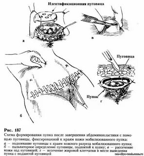 Операция перенос