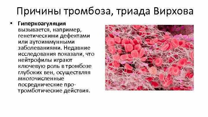 Причины тромбов у женщин. Триада Вирхова тромбоз. Причины тромбообразования. Тромбоз определение причины.