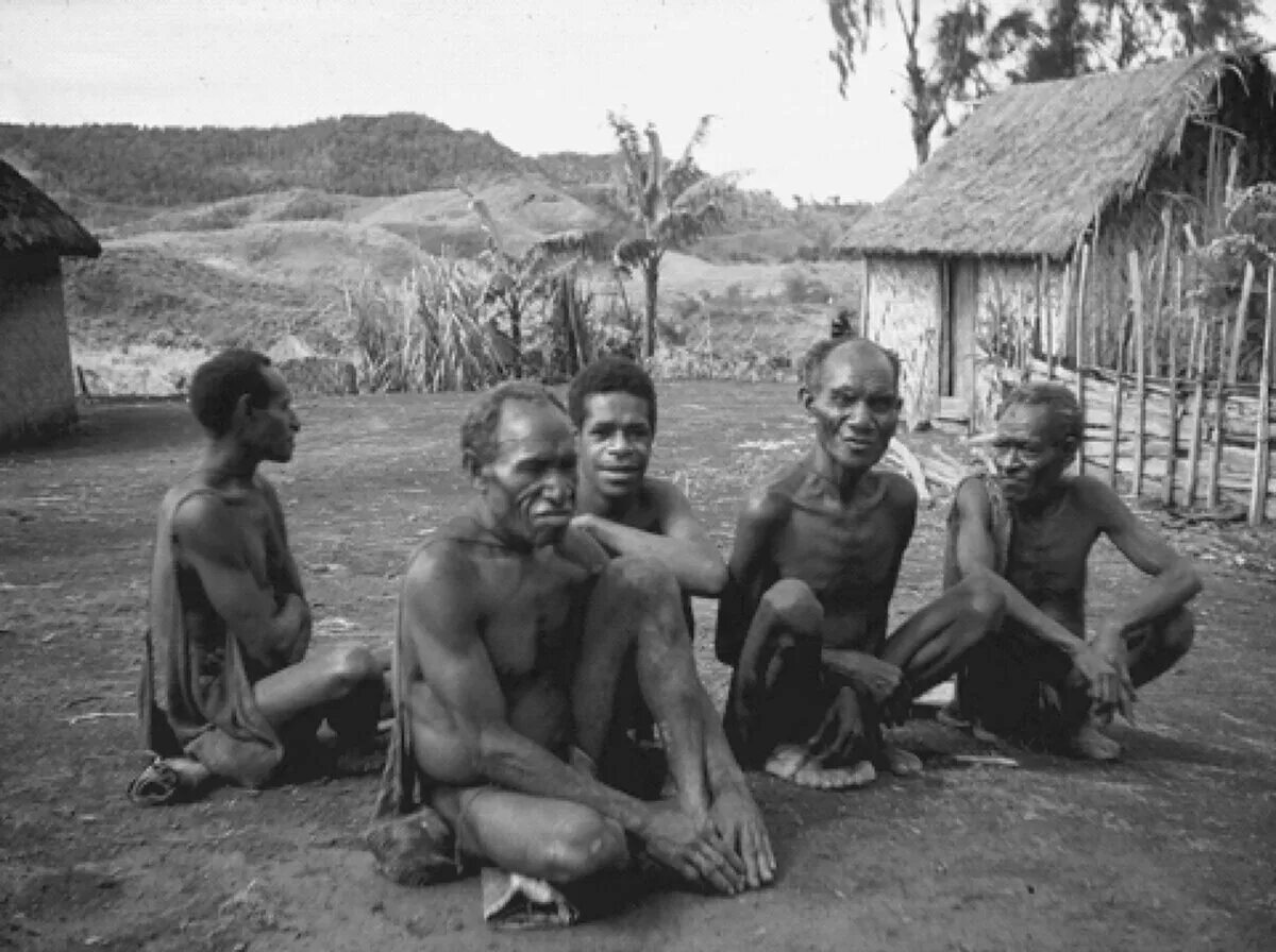 Больные куру. Болезнь Куру у племени Форе. Племя Форе новая Гвинея.