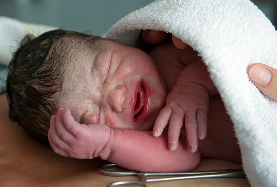 Рождаются ли говорящие дети. Гермафродитизм у новорожденного. Новорожденный ребенок гермафродит. Дети рождаются с волосами.
