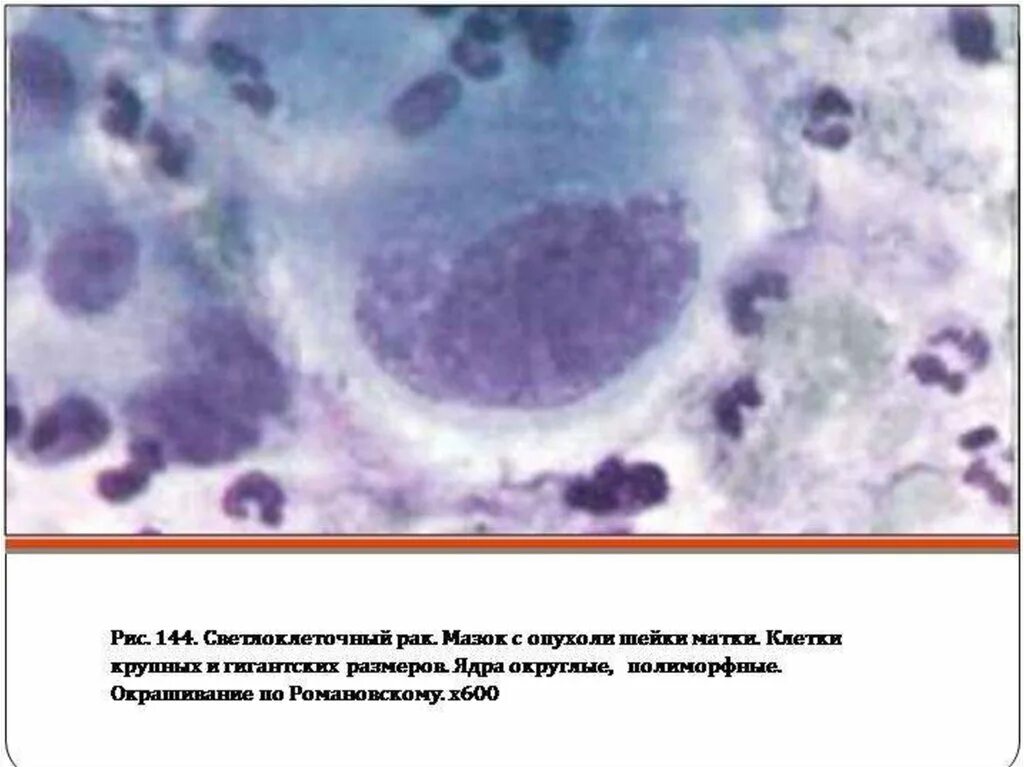 Изменение клеток матки. Гиперкератоз цитология мазка. Цитограмма пролиферация железистого эпителия что это. Карцинома шейки матки клетки. Лейкоплакия шейки матки микроскопия.