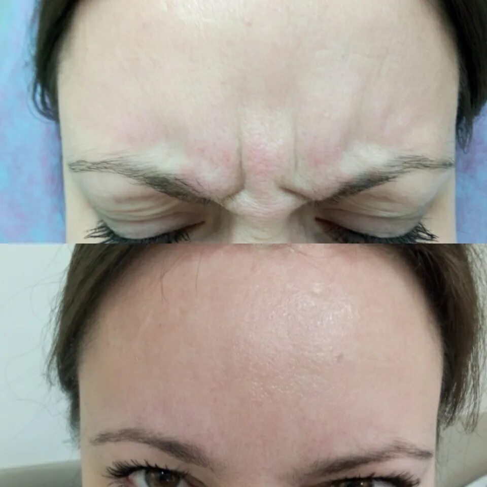 Коррекция мимических морщин. Уколы ботокса. Межбровка ботокс. Диспорт межбровье. Ботулотоксин в косметологии.