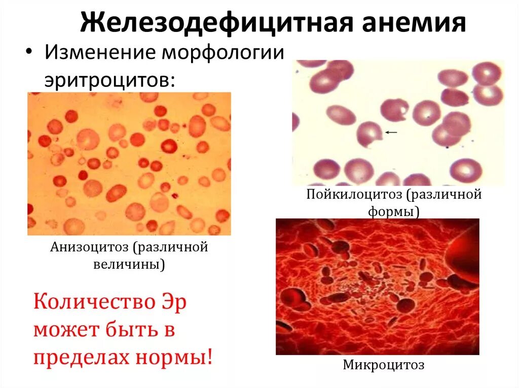 Малокровие эритроцитов. Изменение эритроцитов при железодефицитной анемии. Показатели при микроцитарной анемии. Характерные изменения крови при железодефицитной анемии. Морфология эритроцитов при в12.