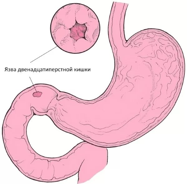 Болезни двенадцатиперстной кишки у ребенка. Язва желудка и 12 перстной кишки. Язвеннаяболезнь луковицы ДКП. Перфоративная язва луковицы 12 перстной кишки.