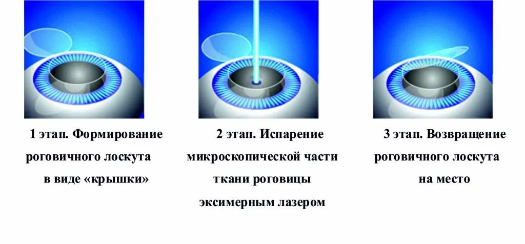 Коррекция зрения какие методы. Коррекция зрения методом ласик. Лазерная коррекция зрения методом Femto-LASIK. Лазерная коррекция зрения принцип метода. Лазерный кератомилез in situ ласик.