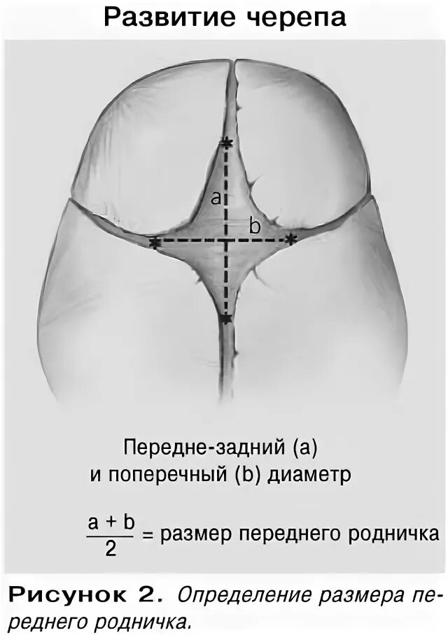 Измерение родничка. Измерение большого родничка грудного ребенка. Как измерять Родничок у грудных детей. Измерение родничка у новорожденного алгоритм. Величина большого родничка.