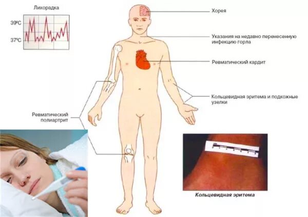 Лихорадка артрите. Острая ревматическая лихорадка симптомы. Острая ревматическая лихорадка диагноз кольцевидная эритема. Диагностика при острой ревматической лихорадки. Эритема при ревматической лихорадке.