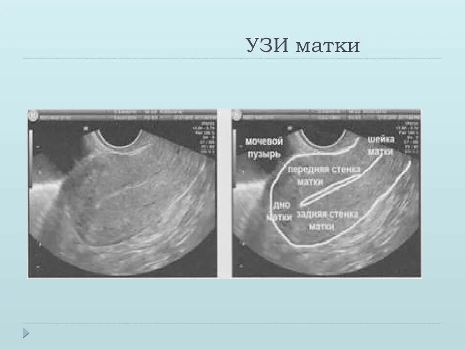 Поперечный срез матки УЗИ. Сагиттальный срез матки на УЗИ. Ультразвуковая анатомия матки и придатков в норме. УЗИ матки трансвагинально. Не видна матка на узи