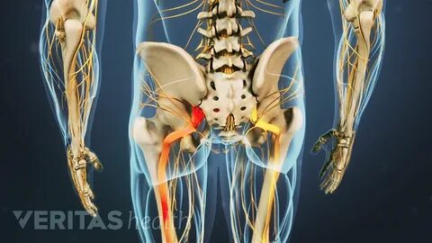 Free shipping on all orders Top 4 Causes of Sciatica, sciatic nerve