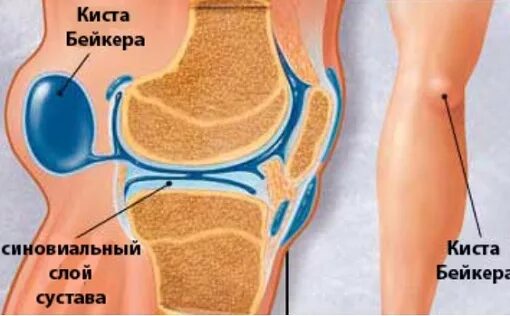 Киста бейкера что это такое