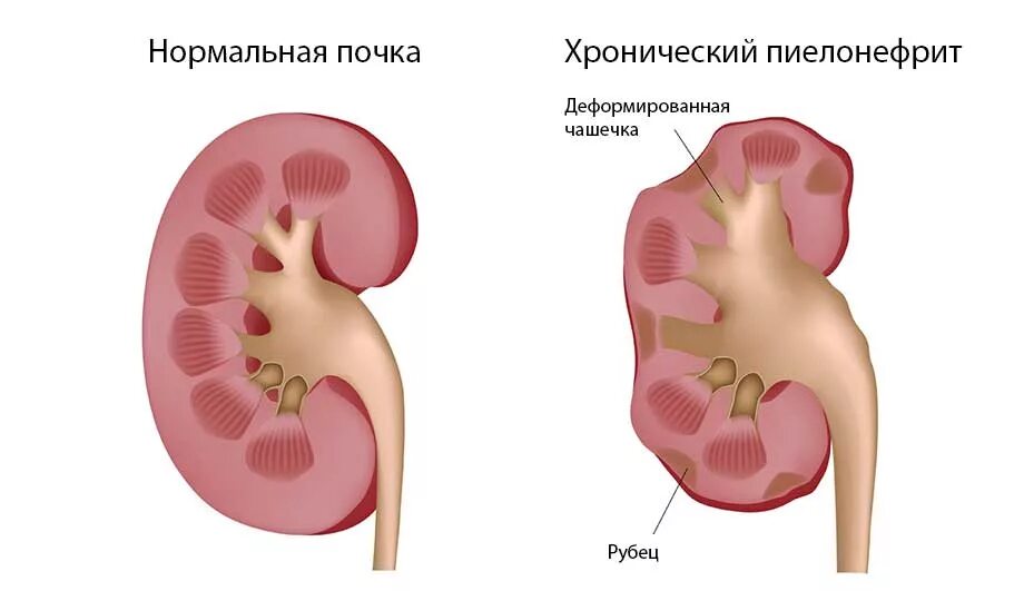 Пиелонефрит поражение почечной лоханки. Полинифрит почек хронический пиелонефрит. Почка пораженная пиелонефритом. Хронический левосторонний пиелонефрит.