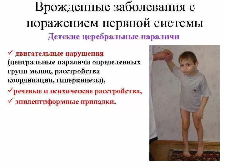 Примером вторичного дефекта при детском церебральном параличе