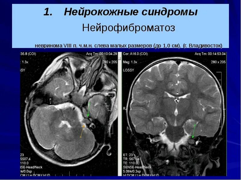Нейрофиброматоз мрт. Нейрофиброматоз мрт головной мозг. нейрофиброматоз головного мозга кт. синдром нейрофиброматоз.