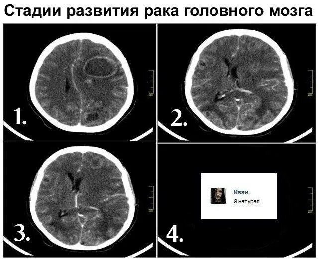 Стадии развития опухоли головного мозга. Объемное образование головного мозга.