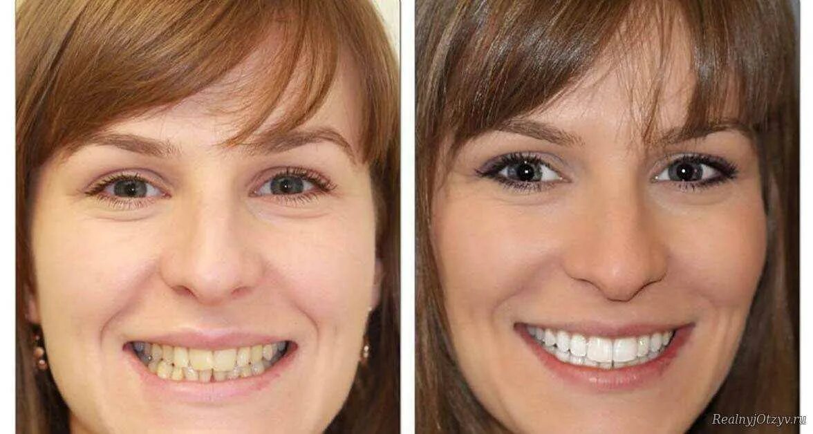 Хорошие зубы. Зубы с винирами до и после. Изменение формы зубов
