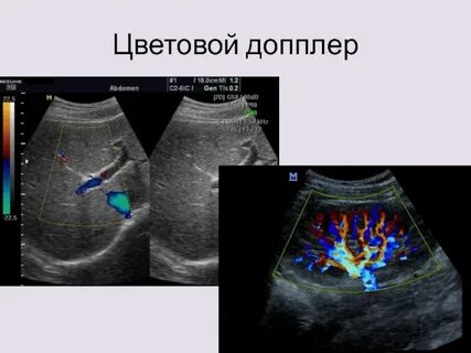 Цветной доплер