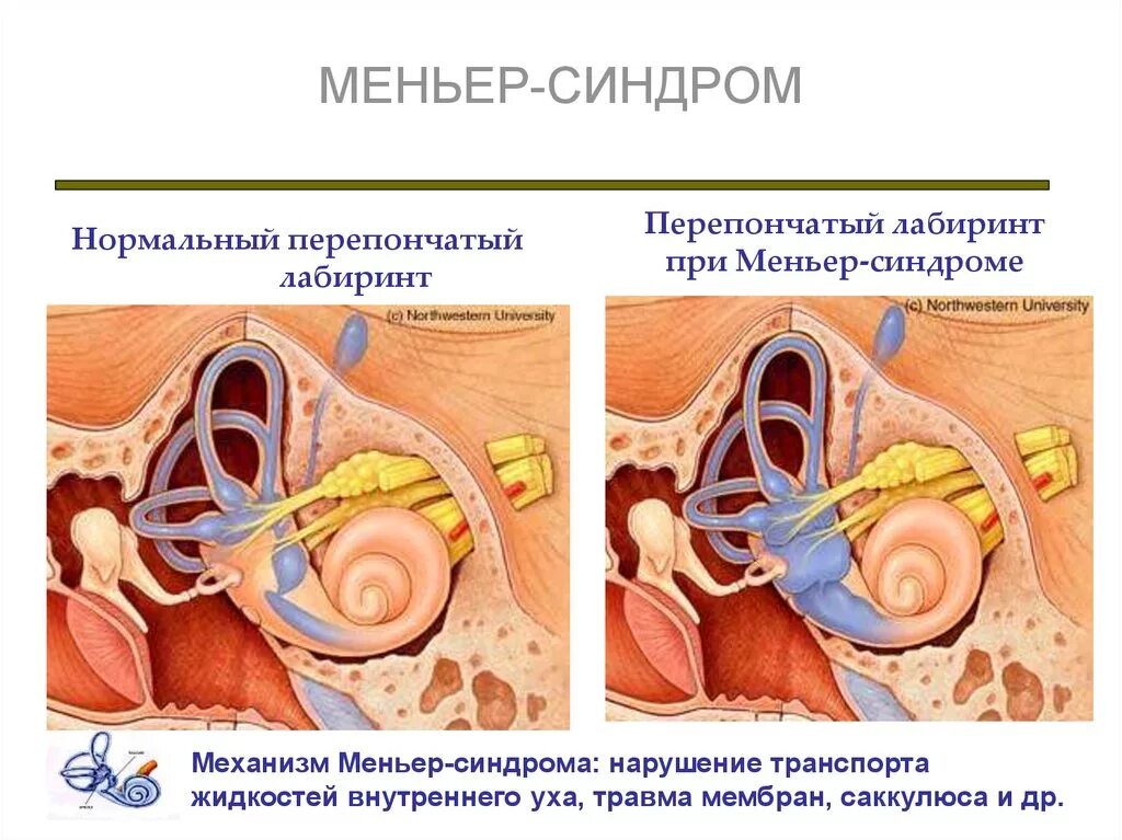 Болезнь Меньера гидропс. Барабанная перепонка при болезни Меньера. Снижения слуха при болезни Меньера.